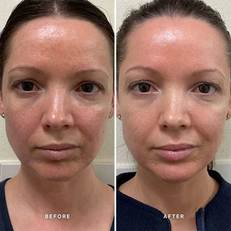 Alpha-H Vitamin B Serum with 5% Niacinamide